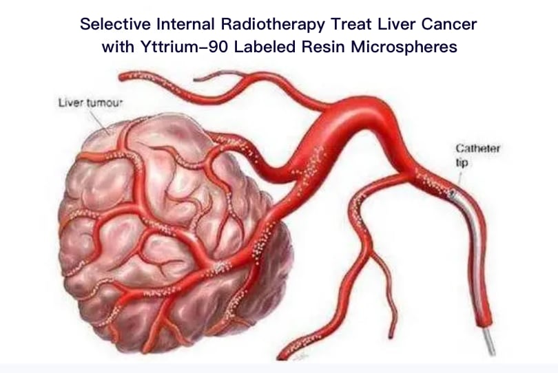 Selective Internal Radiotherapy Treat Liver Cancer with Yttrium-90 Labeled Resin Microspheres